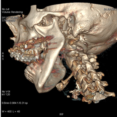 Scanner :reconstruction 3D de la mandibuke